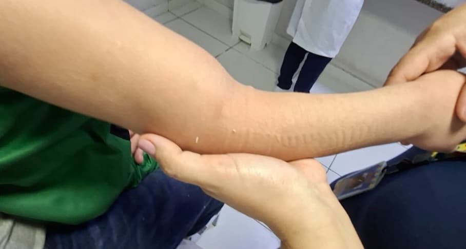 Criança autista de 5 anos tem braço fraturado durante terapia