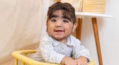  Bebê peludo viraliza na web; entenda a condição que o afeta 