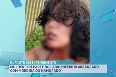 Mulher tem parte do lábio arrancado com mordida de companheiro, em São Luís