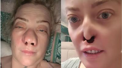 Mulher faz tratamento dentário e fica com ‘buraco’ no rosto: ‘Estou com medo’