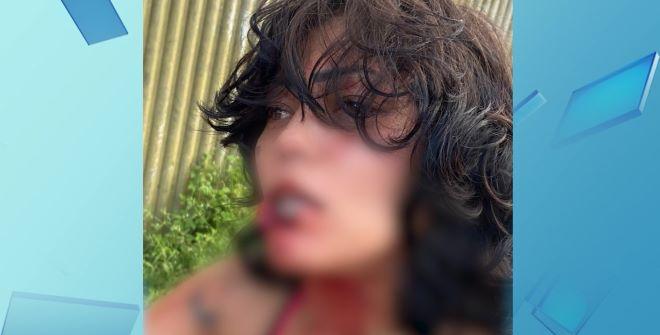 Mulher tem parte do lábio arrancado com mordida de companheiro, em São Luís