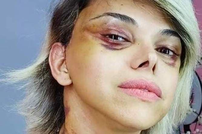 Léo Áquilla assusta fãs ao aparecer com o rosto machucado