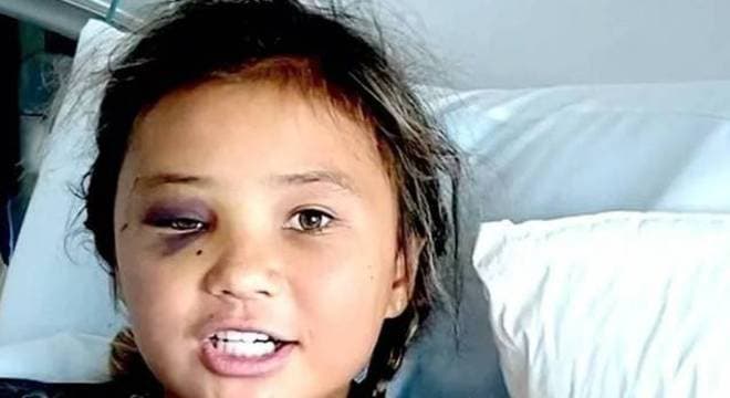 Skatista de 11 anos sofre grave acidente durante manobra