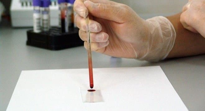 Falta de testes e assintomáticos são 'calcanhar de Aquiles' do Brasil
