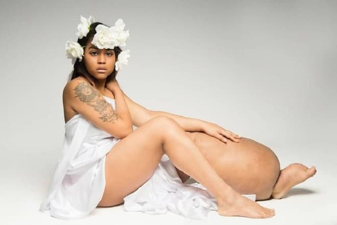 Modelo com perna pesando 20 kg diz que não irá amputá-la