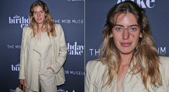 Atriz é mordida no rosto por cachorro minutos antes de evento