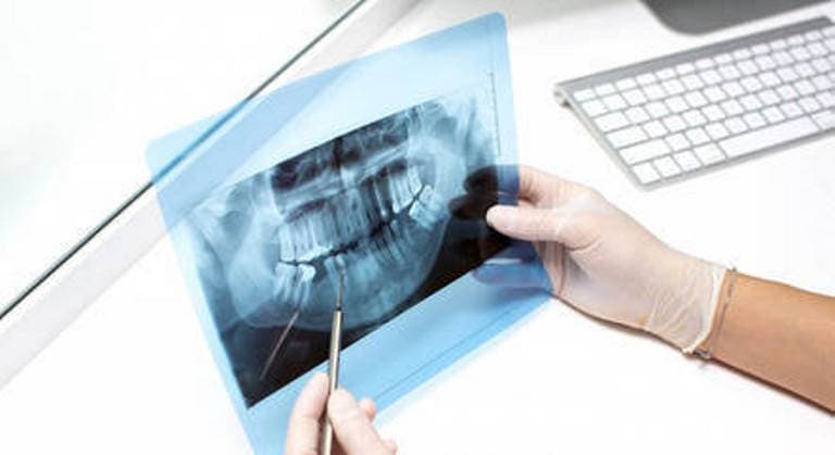 Dentes são a única parte do corpo humano que não desenvolve câncer; entenda o porquê