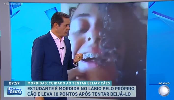 Jovem tem parte do lábio arrancada ao ser mordida pelo próprio cachorro