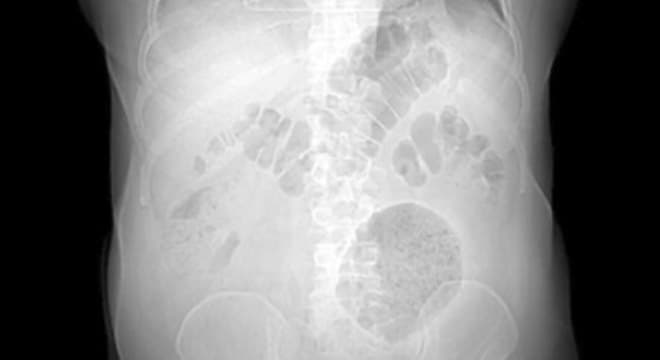 Paciente é diagnosticado com doença raríssima no Rio de Janeiro