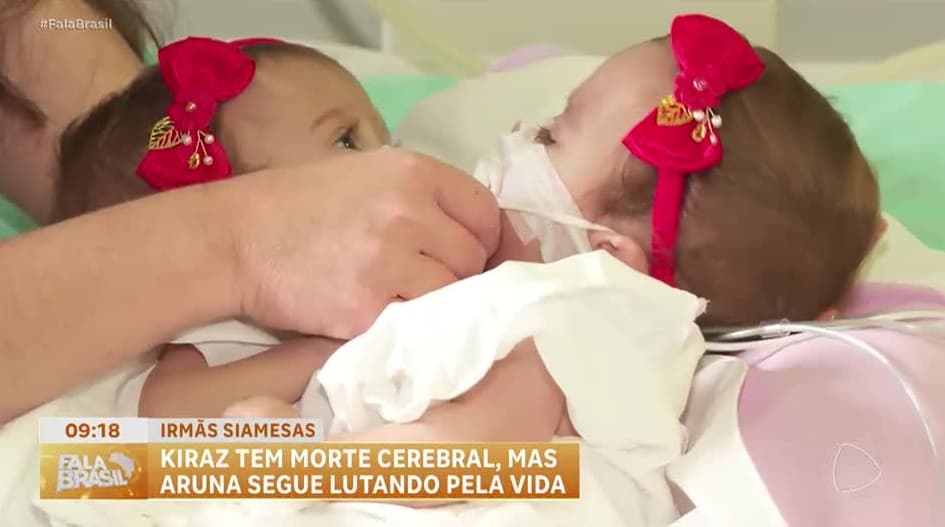 Morre uma das gêmeas siamesas separadas em cirurgia de 20 horas