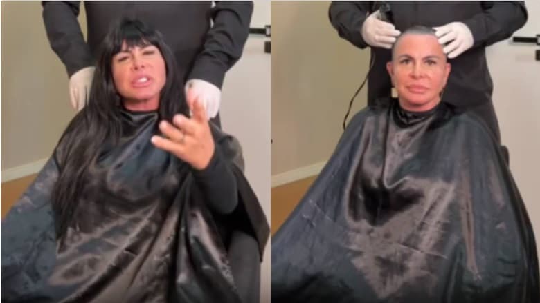 Gretchen raspa a cabeça antes de fazer transplante capilar: ‘Minha alopecia é agressiva’